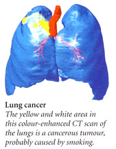 lung cancer